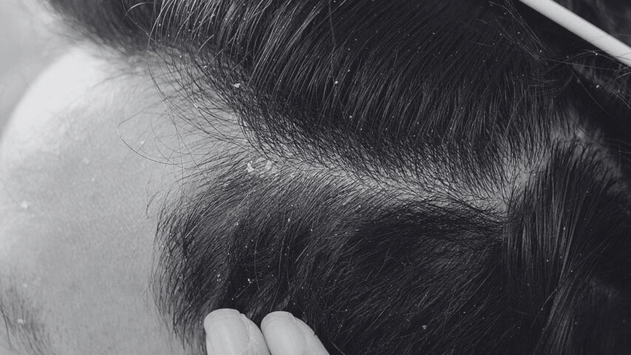 How to Keep Your Scalp Healthy
